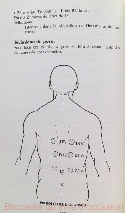 La médecine des ventouses – Image 5