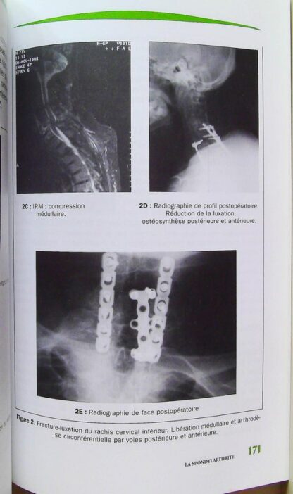 La spondylarthrite – Image 7